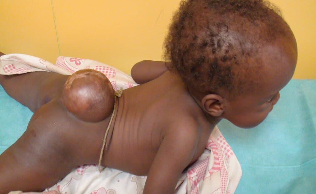 Vivre avec le spina-bifida